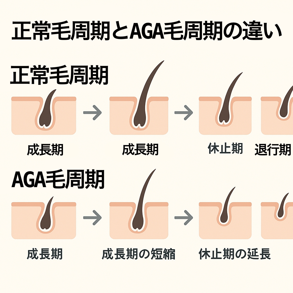正常毛周期とAGA毛周期の違いを図解：成長期が短縮され、細く弱い毛が増える仕組み